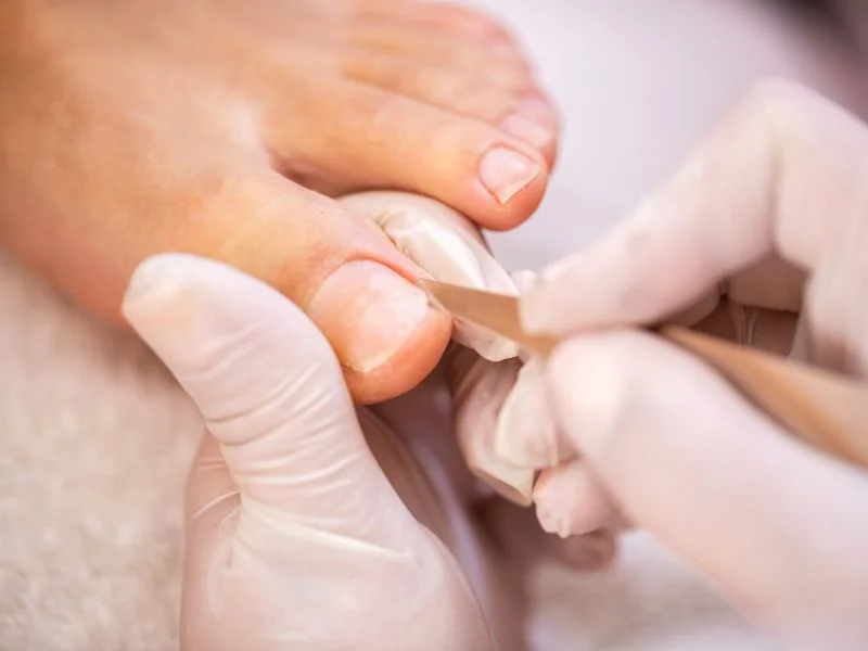 Ingrown Toenails service at Sole Summit Podiatry
